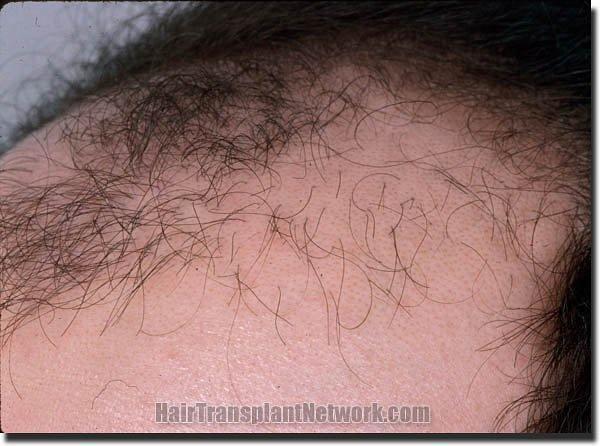 Hair restoration procedure results