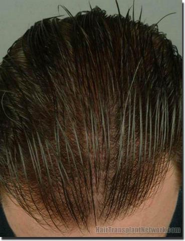 Hair restoration procedure results