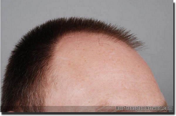 Hair restoration procedure results