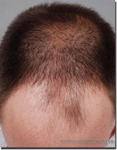 Hair restoration procedure results