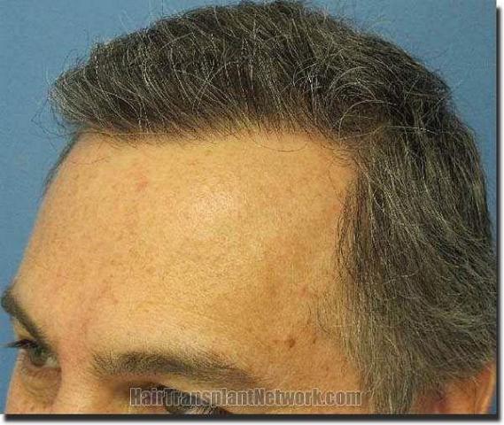 Hair restoration procedure results