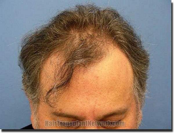 Hair restoration procedure results