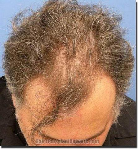 Hair restoration procedure results