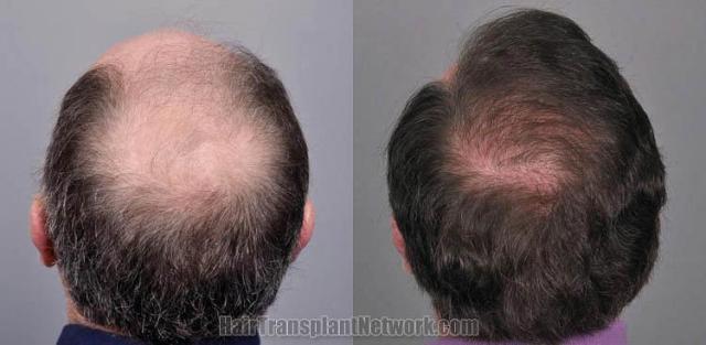 Hair restoration procedure before and after pictures