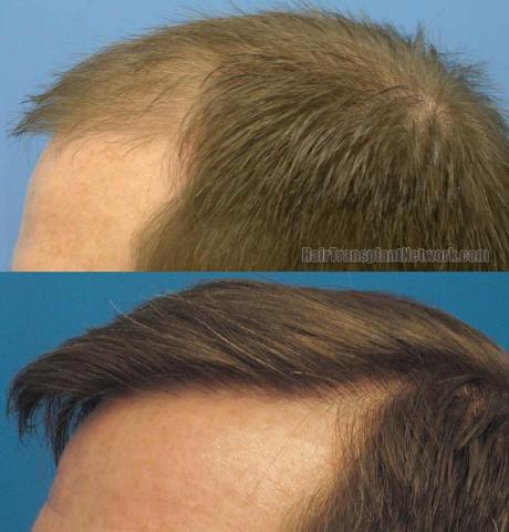 Hair transplant surgery before and after pictures