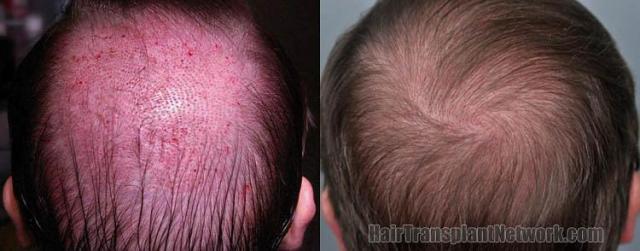 Hair transplantation surgery before and after images