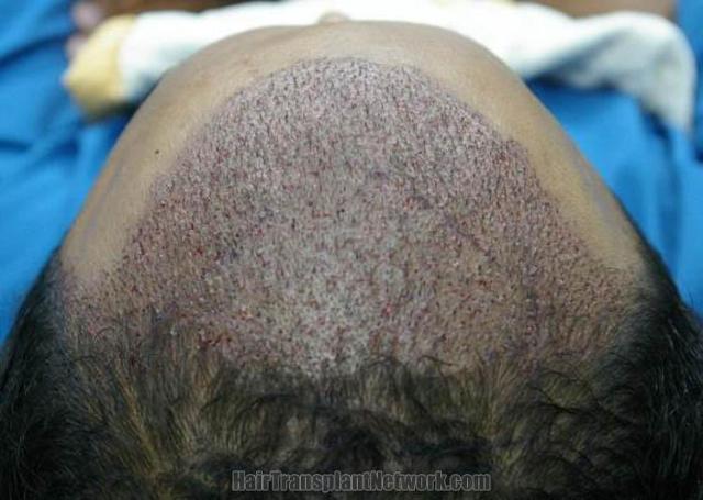 Hair restoration procedure before and after pictures