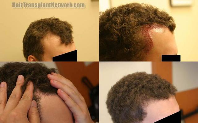 Hair transplantation surgery before and after images