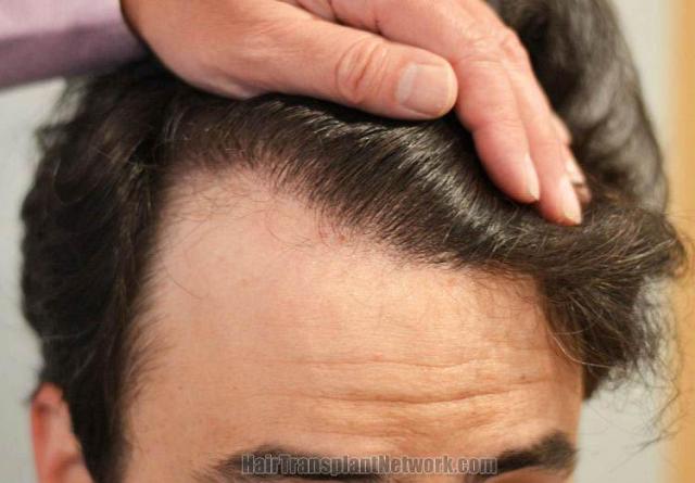 Hair transplantation surgery before and after pictures