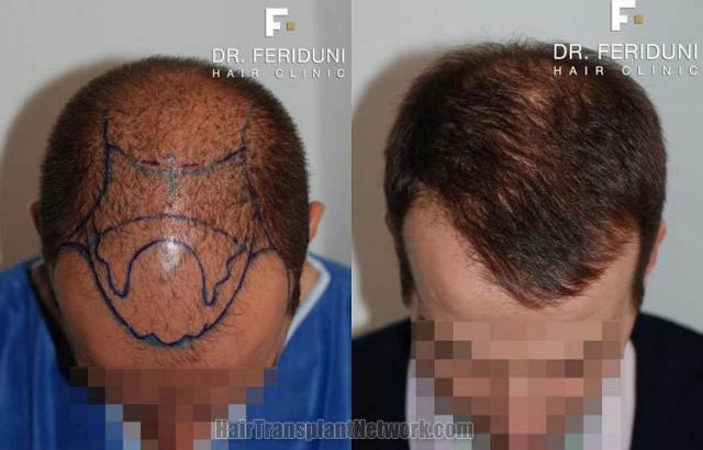 Before and after hair transplant procedure images