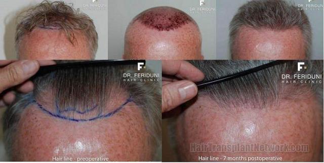 Front views showing Follicular Unit Extraction hair transplant