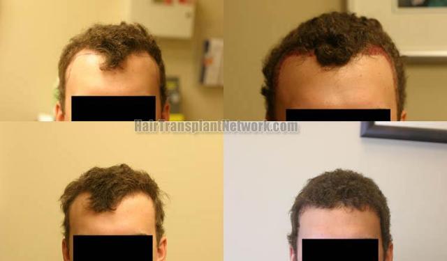 Hair restoration procedure before and after results