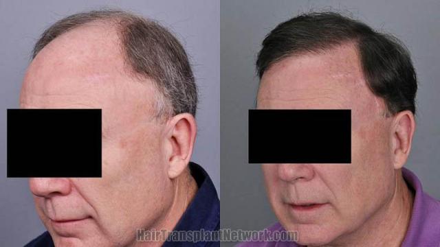 Hair transplantation surgery before and after pictures