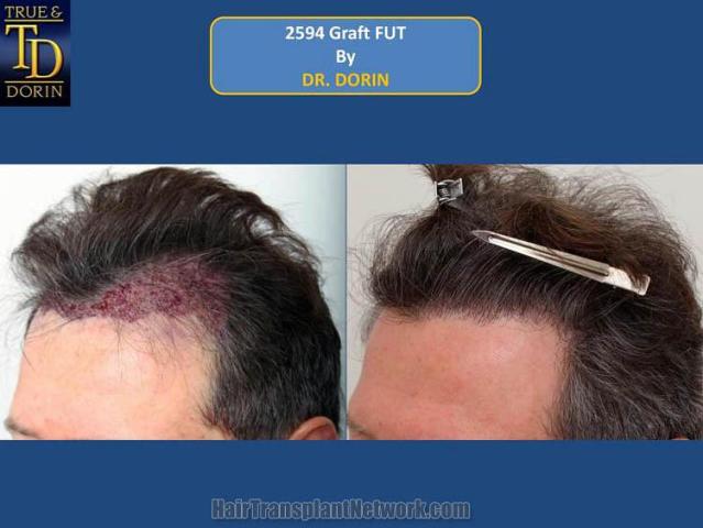 Hair transplant surgery before and after images