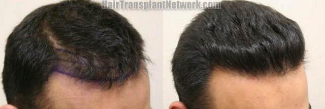 Hair transplant procedure results - Right view