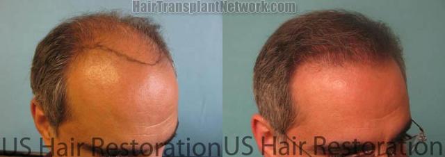 Hair restoration procedure before and after results