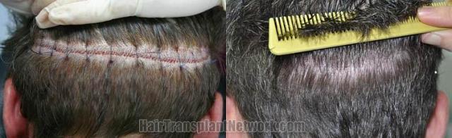 Hair transplant surgery before and after images