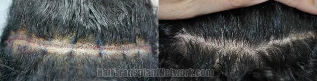 Surgical hair transplantation result photographs