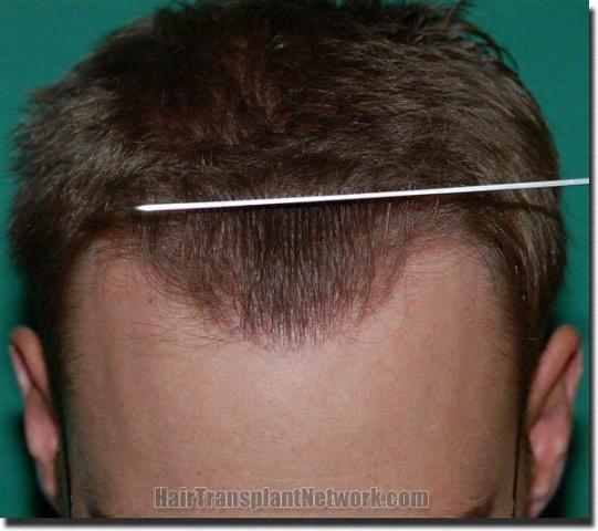 Hair restoration procedure results