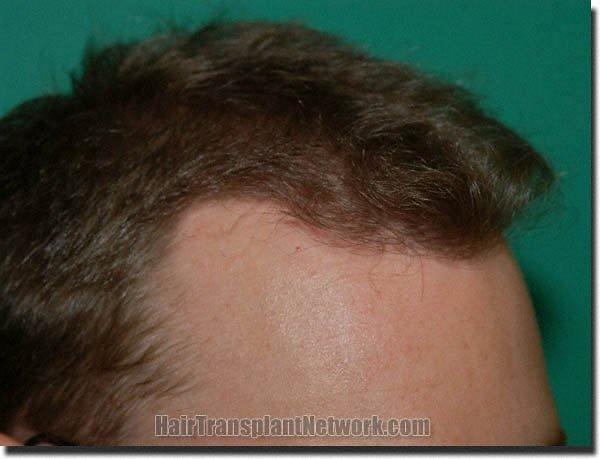 Hair restoration procedure results