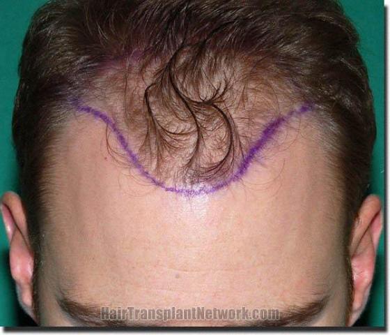 Hair restoration procedure results