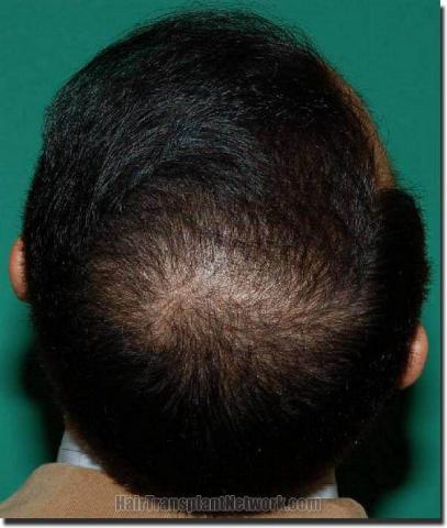 Hair restoration procedure results