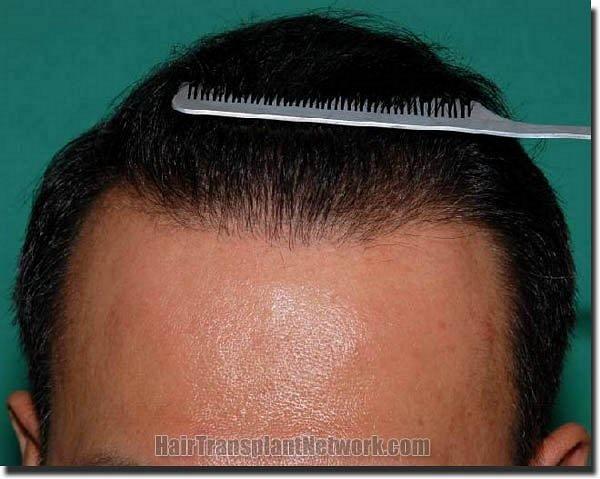 Hair restoration procedure results