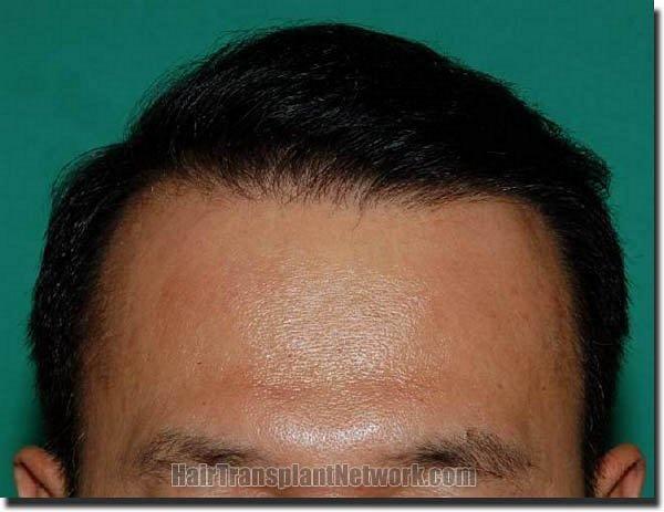 Hair restoration procedure results