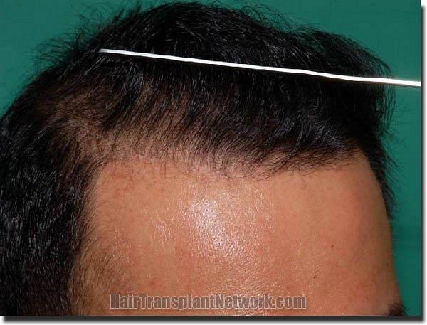 Hair restoration procedure results