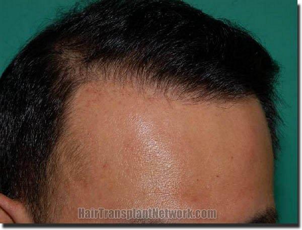 Hair restoration procedure results