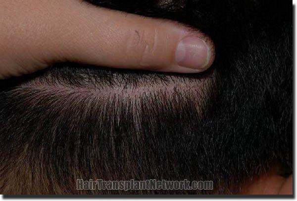 Hair restoration procedure results