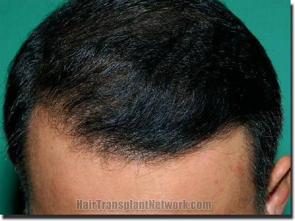 Hair restoration procedure results