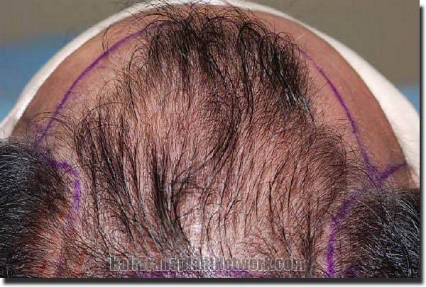 Hair restoration procedure results