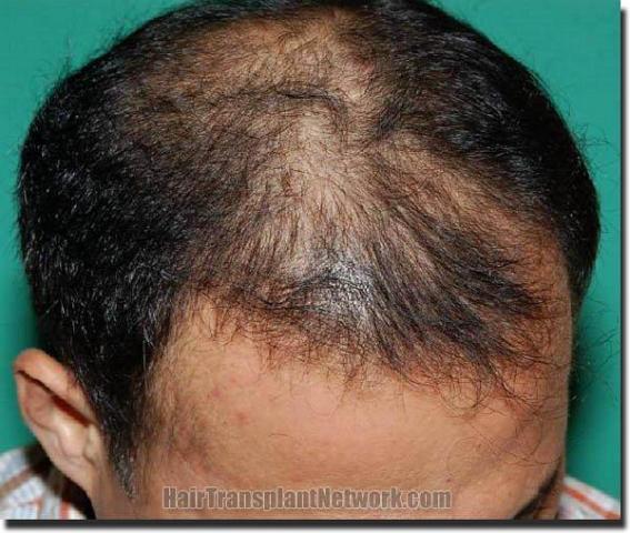 Hair restoration procedure results