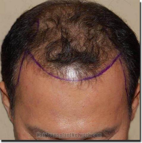 Hair restoration procedure results