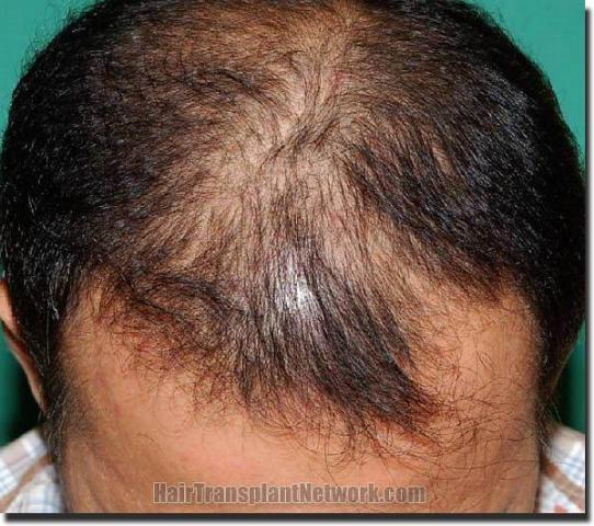 Hair restoration procedure results