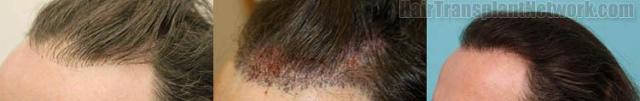 Before and after hair transplant left view images