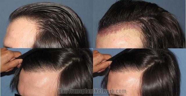 Hair transplant photos showing left view