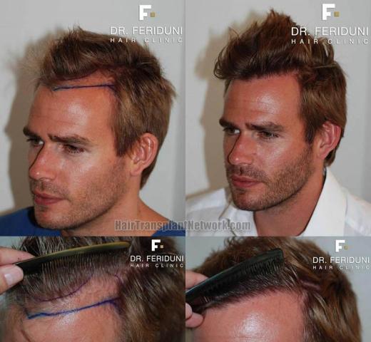 Hair transplantation surgery before and after images