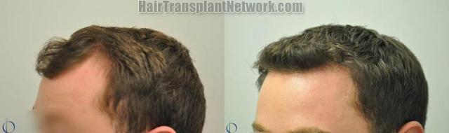 Hair transplantation surgery before and after pictures