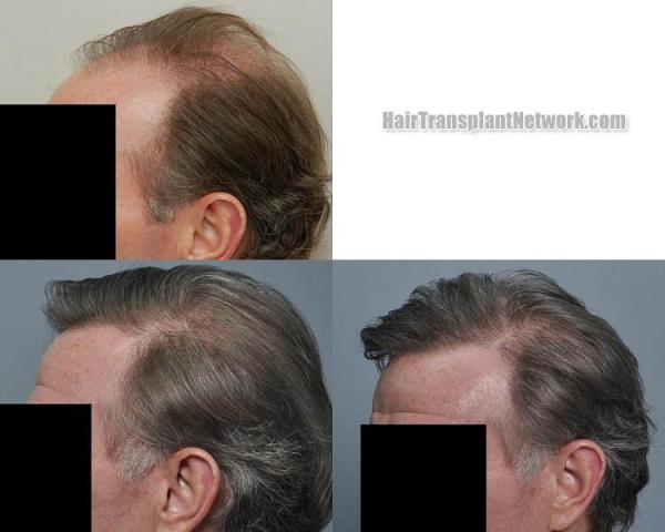 Hair restoration procedure before and after pictures