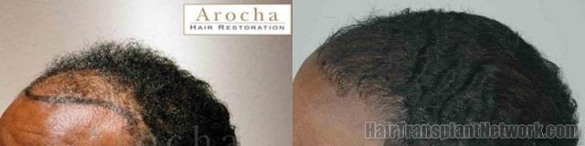 Hair transplantation surgery before and after photos