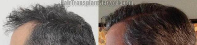 Hair transplantation surgery before and after pictures