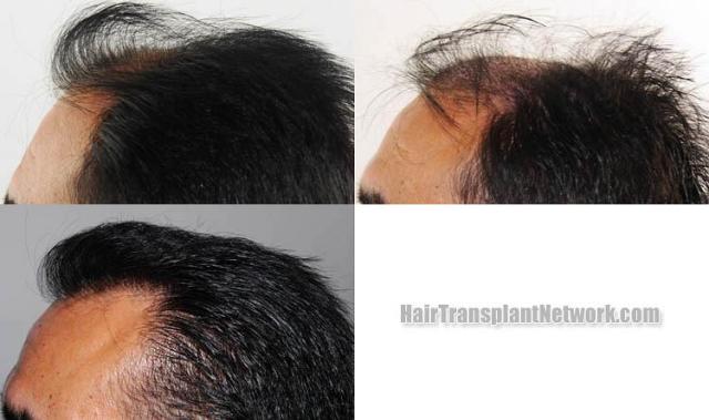 Hair transplantation surgery procedure before and after photos