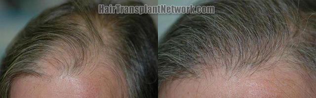 Left side of patient, before and after 