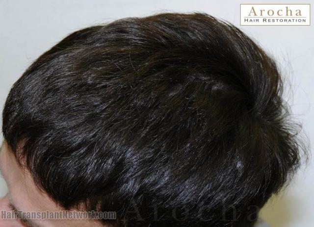 Hair transplantation surgery before and after pictures