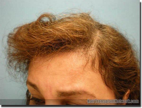 Hair restoration procedure results