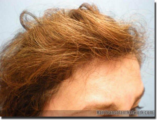 Hair restoration procedure results