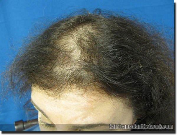 Hair restoration procedure results