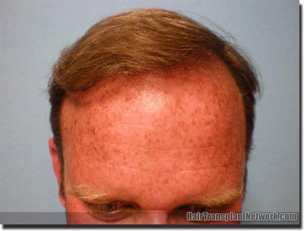 Hair restoration procedure results